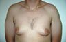 Gynecomastia Adolescents - Before and After Treatment Photos - man breasts (frontal view) patient 35
