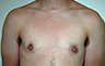 Female to Male, Top Surgery: Before and After Treatment Photos: male patient 1 (brests, frontal view)