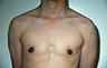 Female to Male, Top Surgery: Before and After Treatment Photos: male patient 6 (brests, frontal view)