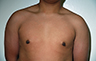 Gynecomastia Adolescents - Before and After Treatment Photos - man breasts (frontal view) patient 36
