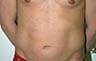 Torsoplasty - Before and After Treatment photos: male body (breasts), front view, patient 31