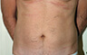 Torsoplasty - Before and After Treatment photos: male body (breasts), front view, patient 33