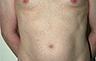 Torsoplasty - Before and After Treatment photos: male body (breasts), front view, patient 34