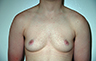 Female to Male, Top Surgery: Before and After Treatment Photos: male patient 11 (brests, frontal view)