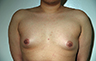 Female to Male, Top Surgery: Before and After Treatment Photos: male patient 12 (brests, frontal view)