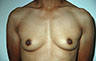 Female to Male, Top Surgery: Before and After Treatment Photos: male patient 15 (brests, frontal view)