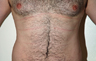 Torsoplasty - Before and After Treatment photos: male body (breasts), front view, patient 35
