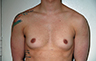 Female to Male, Top Surgery: Before and After Treatment Photos: male patient 17 (brests, frontal view)