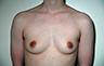 Female to Male, Top Surgery: Before and After Treatment Photos: male patient 18 (brests, frontal view)