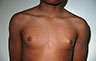 Gynecomastia Adolescents - Before and After Treatment Photos - man breasts (frontal view) patient 40