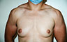 Female to Male, Top Surgery: Before and After Treatment Photos: male patient 25 (brests, frontal view)
