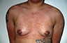 Female to Male, Top Surgery: Before and After Treatment Photos: male patient 26 (brests, frontal view)