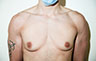 Female to Male, Top Surgery: Before and After Treatment Photos: male patient 27 (brests, frontal view)