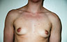 Female to Male, Top Surgery: Before and After Treatment Photos: male patient 27 (brests, frontal view)