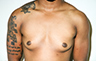 Female to Male, Top Surgery: Before and After Treatment Photos: male patient 29 (brests, frontal view)
