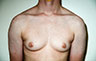 Female to Male, Top Surgery: Before and After Treatment Photos: male patient 30 (brests, frontal view)