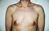 Female to Male, Top Surgery: Before and After Treatment Photos: male patient 31 (brests, frontal view)