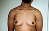 Female to Male, Top Surgery: Before and After Treatment Photos: male patient 32 (brests, frontal view)