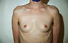 Female to Male, Top Surgery: Before and After Treatment Photos: male patient 35 (brests, frontal view)