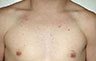 Gynecomastia Adolescents - Before and After Treatment Photos - man breasts (frontal view) patient 1