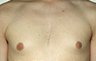 Gynecomastia Adolescents - Before and After Treatment Photos - man breasts (frontal view) patient 2