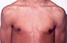 Gynecomastia Adolescents - Before and After Treatment Photos - man breasts (frontal view) patient 3