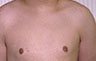 Gynecomastia Adolescents - Before and After Treatment Photos - man breasts (frontal view) patient 4