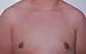 Gynecomastia Adolescents - Before and After Treatment Photos - man breasts (frontal view) patient 5