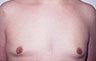 Gynecomastia Adolescents - Before and After Treatment Photos - man breasts (frontal view) patient 6