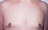 Gynecomastia Adolescents - Before and After Treatment Photos - man breasts (frontal view) patient 7