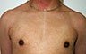 Gynecomastia Adolescents - Before and After Treatment Photos - man breasts (frontal view) patient 8