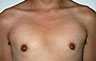 Gynecomastia Adolescents - Before and After Treatment Photos - man breasts (frontal view) patient 9