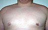 Gynecomastia Adolescents - Before and After Treatment Photos - man breasts (frontal view) patient 11