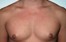 Gynecomastia Adolescents - Before and After Treatment Photos - man breasts (frontal view) patient 12