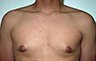 Gynecomastia Adolescents - Before and After Treatment Photos - man breasts (frontal view) patient 13