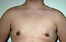 Gynecomastia Adolescents - Before and After Treatment Photos - man breasts (frontal view) patient 14