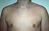 Gynecomastia Adolescents - Before and After Treatment Photos - man breasts (frontal view) patient 15