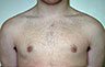 Gynecomastia Adolescents - Before and After Treatment Photos - man breasts (frontal view) patient 16