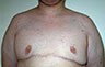 Gynecomastia Adolescents - Before and After Treatment Photos - man breasts (frontal view) patient 17
