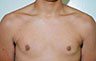 Gynecomastia Adolescents - Before and After Treatment Photos - man breasts (frontal view) patient 19