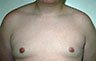 Gynecomastia Adolescents - Before and After Treatment Photos - man breasts (frontal view) patient 20
