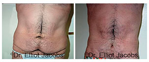 Before and After Treatment Photos - TORSOPLASTY PROCEDURE - male patient, front view (body)
