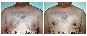 Before and After Treatment Photos - GYNECOMASTIA SURGERY FOR OVERWEIGHT AND OBESE MEN - man patient, front view (breasts)