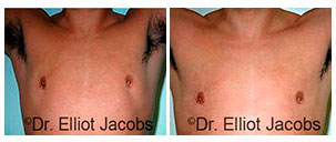 Before and After Treatment Photos - Crater Deformities - man patient, front view