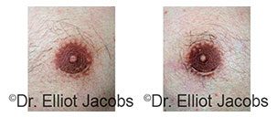 Before and After Treatment Photos - Skin Abnormalities - man patient, front view (nipples)