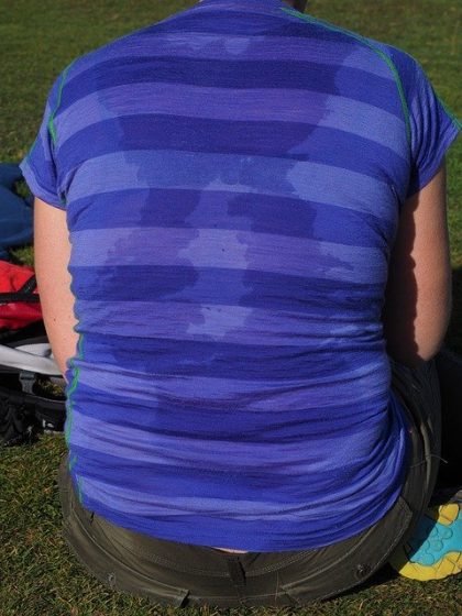 New York hyperhidrosis