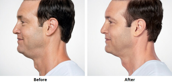 Gynecomastia NYC. Before and After Kybella Photos - male (left side view) patient 1