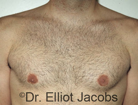 Male breast, after gynecomastia Adolescent treatment, front view, patient 2