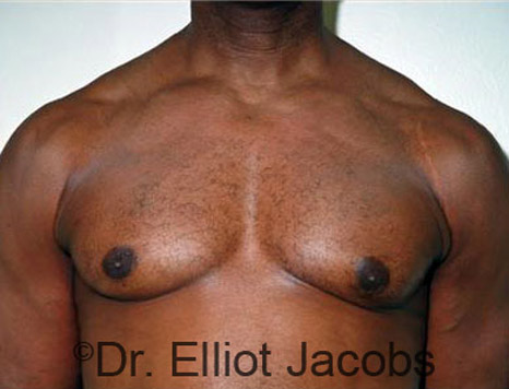 Male breast, after Gynecomastia Surgery for Bodybuilders, front view, patient 1