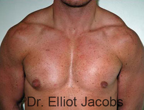 Male breast, after Gynecomastia Surgery for Bodybuilders, front view, patient 3